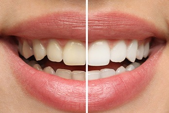 A woman’s smile before and after teeth whitening