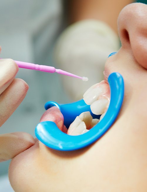 Child receiving fluoride treatment