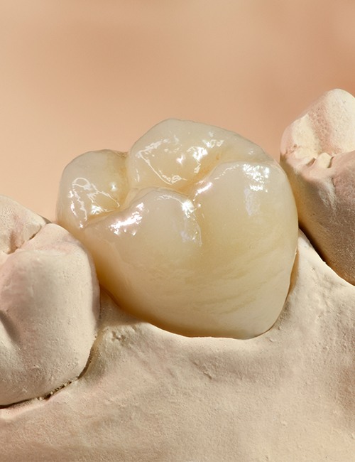 Model smile with metal free dental crown restoration