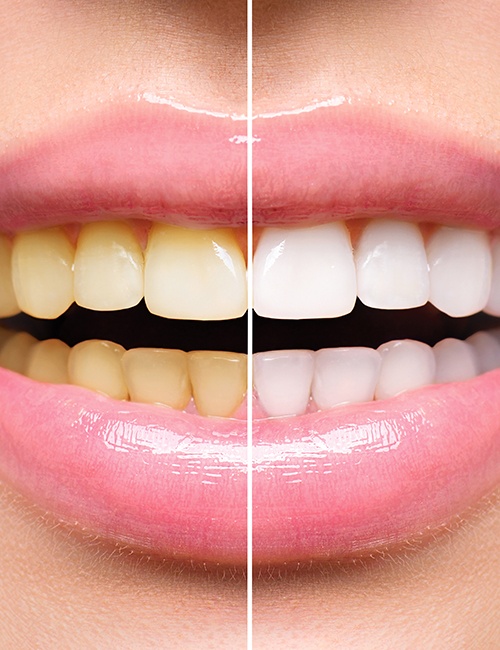 Smile before and after teeth whitening