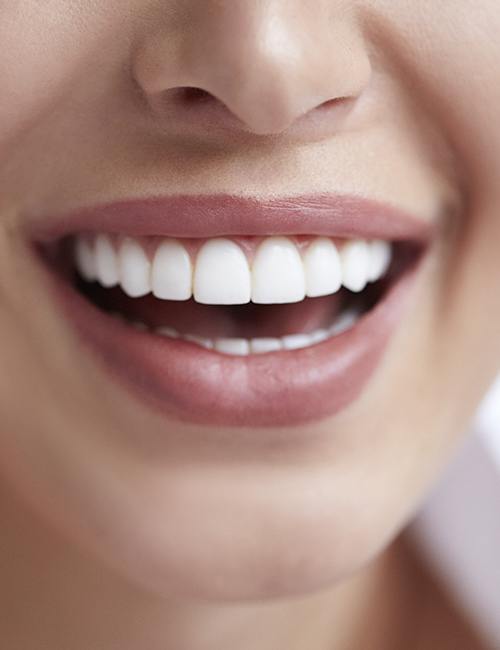 Closeup of flawless smile after gum recontouring