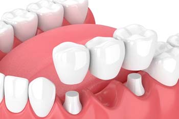 dental bridge replacing a single missing tooth