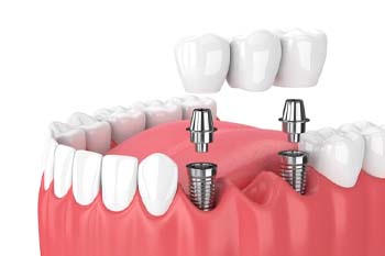 dental bridge being anchored onto two dental implants 