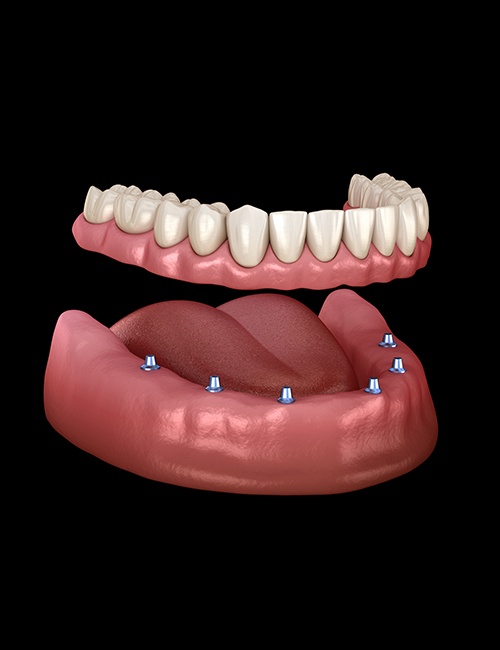 Animated dental implant supported denture placement