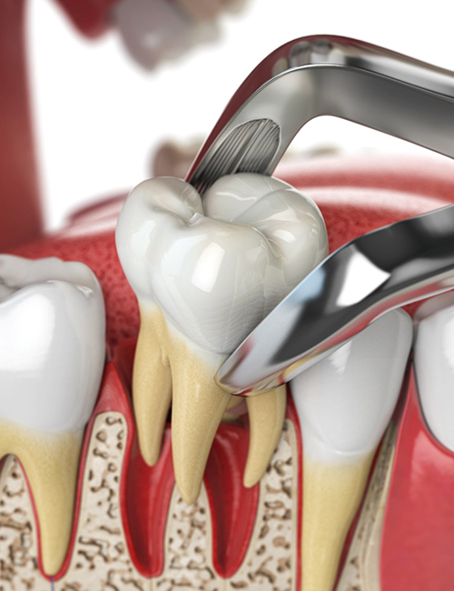 3D render of a tooth extraction