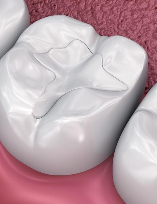 illustration of tooth-colored fillings in Copperas Cove