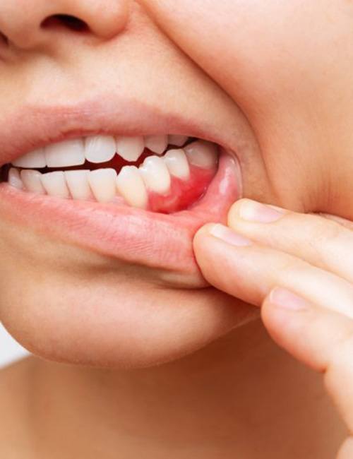 Woman pulling her lip back to reveal red gums