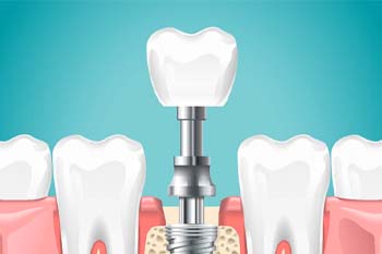 illustration of the parts of dental implants in Copperas Cove