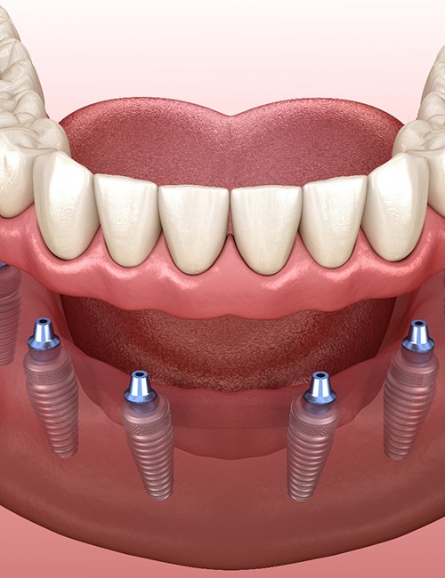 Six implants for supporting implant dentures in Copperas Cove, TX