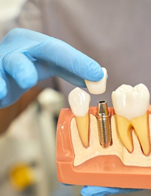 dentist putting a crown on a dental implant model