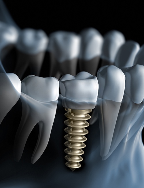 dental implant being placed in the lower jaw