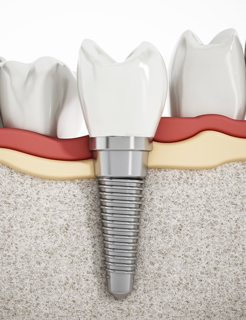 Animated dental implant supported dental crown