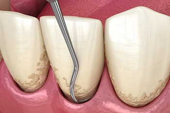Illustration of teeth receiving scaling and root planing