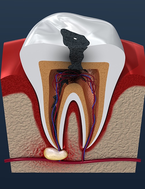 Animated tooth in need of root canal therapy