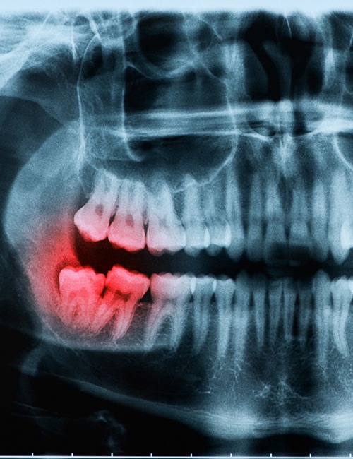 teenager toothache for wisdom tooth extraction in Copperas Cove 
