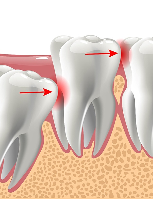 X-ray of wisdom tooth extraction in Copperas Cove 