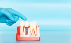 Hand pointing to model that demonstrates the basics of dental implants